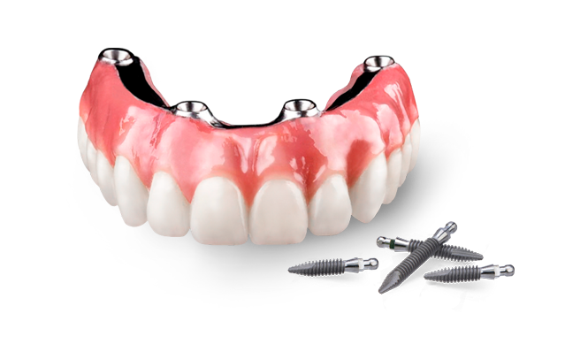 cost of all on 4 fixed hybrid denture in Mexico