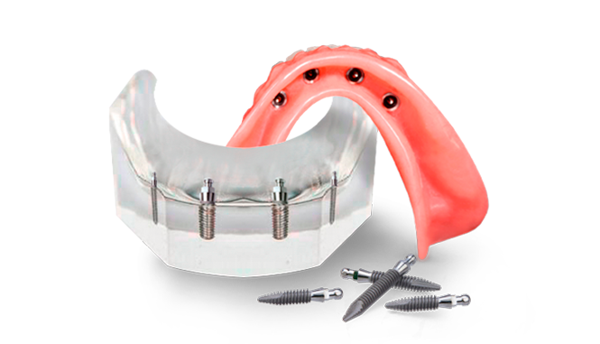 Snap on dentures with Regular implants in mexico
