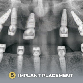 All on 4 Dental Implants Procedure Cancun - Step 5