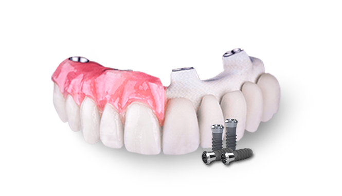 All On 4 fixed hybrid dentures in Mexico 