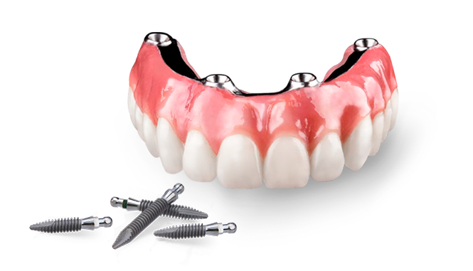 All On 4 fixed hybrid dentures in Mexico