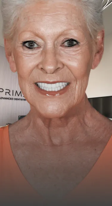  Close-up image of a complete smile restored with All-on-4 dental implants. Prime Advanced Dentistry in Cancun offers All-on-4 treatment packages.