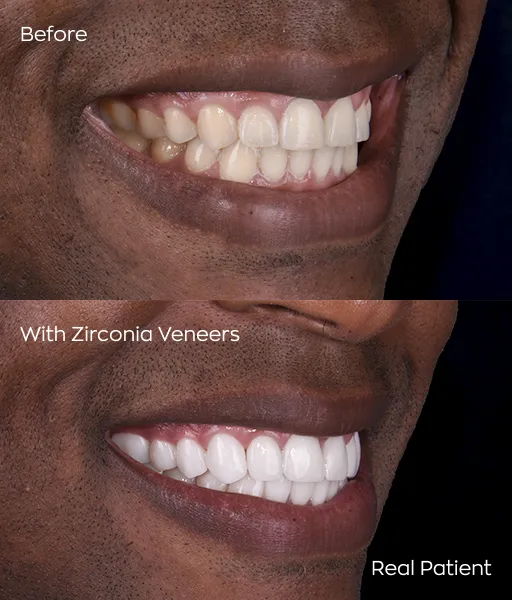 Stunning before and after comparison of a patient who received dental veneers in Cancun, Mexico