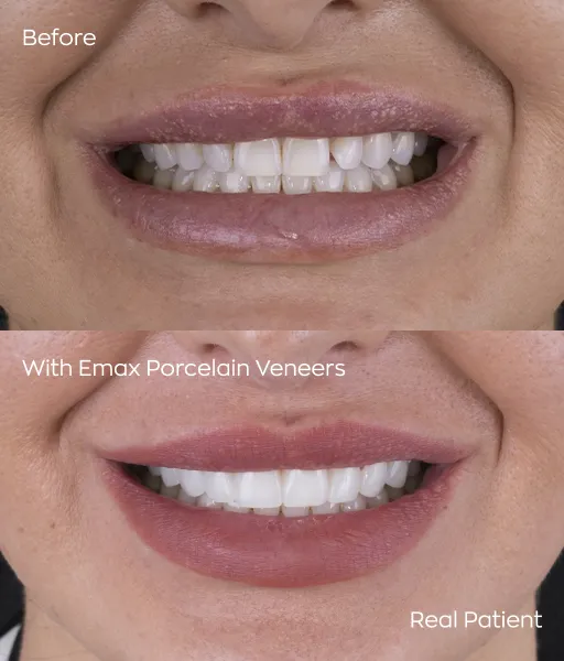 Before and after results of dental veneers at Cancun clinic showcasing remarkable smile transformation