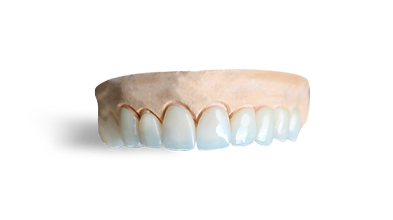 composite veneers cost in Cancun Mexico