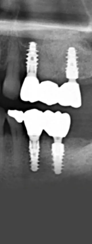 Close-up of a dental crown and bridge placed over implants, demonstrating advanced dental work