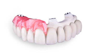 cost of all on 4 fixed hybrid denture in Mexico