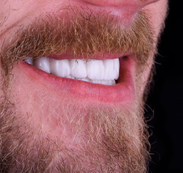 close-up shot a at young male's smile after being restored with implant bridges. 