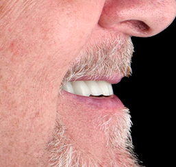 Close up shot at male patient's smile that was restored with dental implants in Mexico