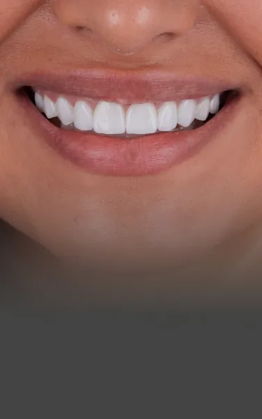 Lumineers procedure at a Cancun dental clinic, offering a minimally invasive solution for a brighter, straighter smile