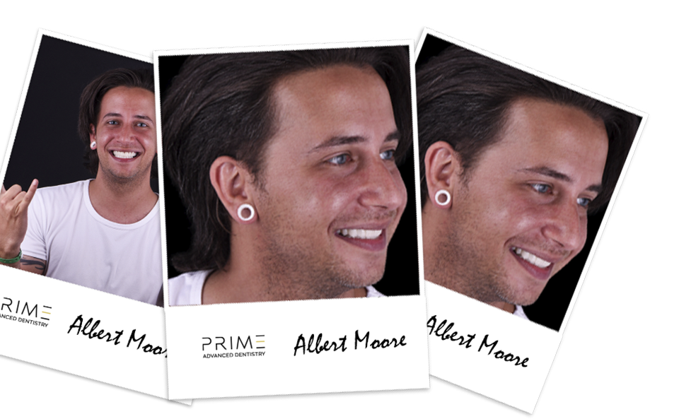 PRIME Dental Veneers in Cancun Transform Your Smile