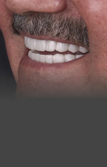 Patient showcasing a flawless smile after receiving dental veneers at a Cancun clinic.