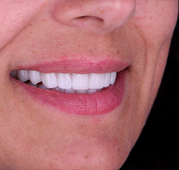 e-Max veneers patient after shot close up in Cancun Mexico