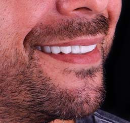 close-up shot at a patients smile with zirconia crowns