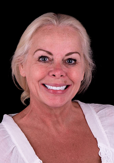 middle age woman showing her smile after getting full mouth dental implants in Mexico