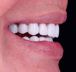 close up shot at a woman patient who got her teeth restored with full mouth dental implants in Mexico