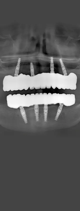 Full-mouth X-ray showing dental implants placement in Cancun