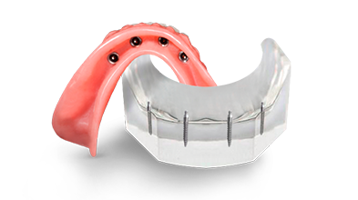 cost of mini implant snap-on dentures in Mexico