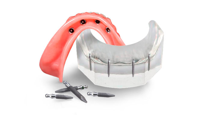 Mini implant snap-on denture for the lower jaw