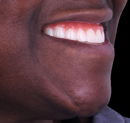 close-up shot at a black woman patient smile with snap-on dentures