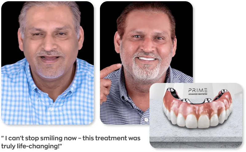 All On 4 fixed hybrid dentures in Mexico