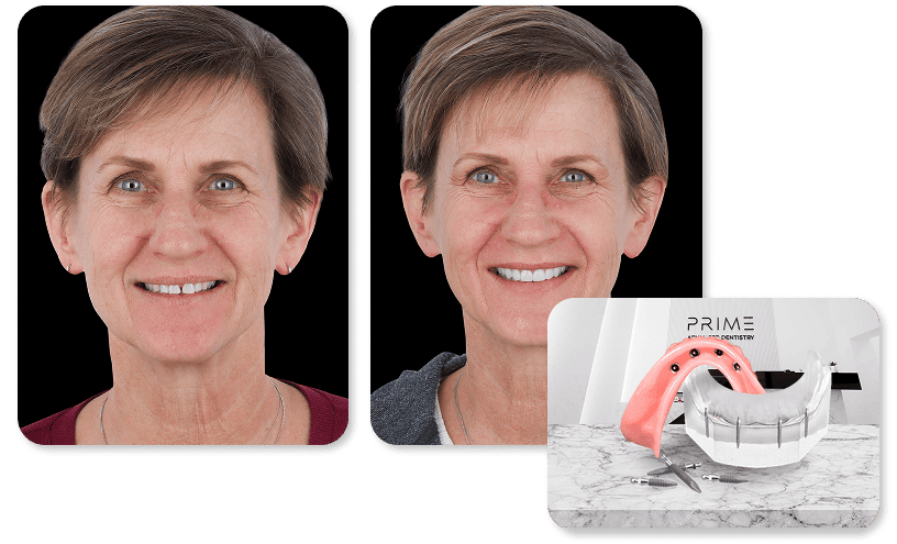 Snap In Denture with Ball Abutments Fixed, before and after results at Prime Advanced Dentistry