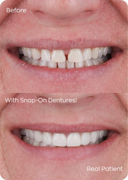 Snap-in-dentures Mexico before and after results