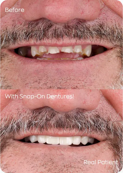 Before and after photos of smile with snap in dentures patient in mexico