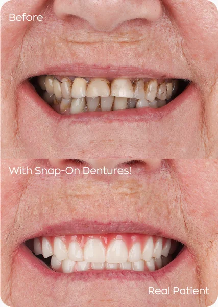 Cancun dental vacation patient with Snap on dentures before and after pictures