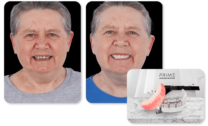 Snap In Dentures with Titanium Bar-Retained, before and after results at Prime Advanced Dentistry