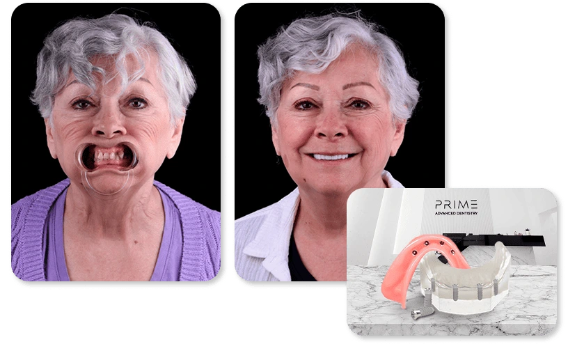 Snap In Dentures with Locators Retained, before and after results at Prime Advanced Dentistry