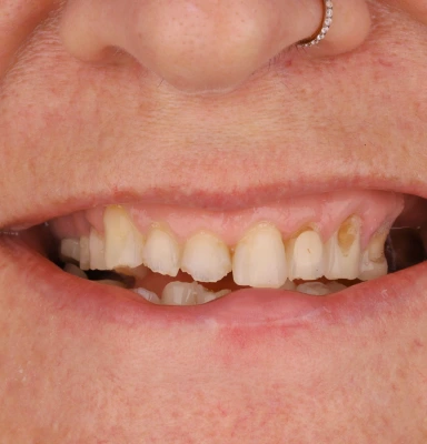 Photo of patient before dental procedure with dentist in mexico