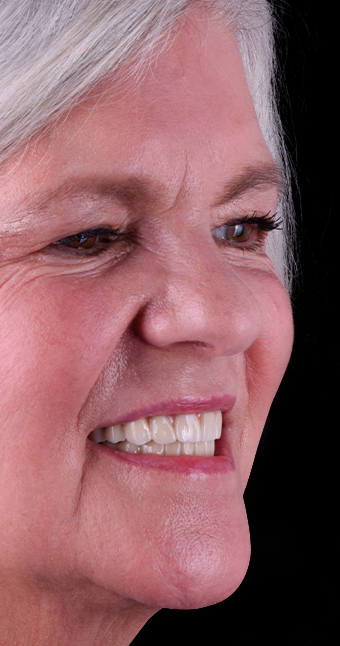 Elder patient from Prime Advanced Dentistry smiling with a single tooth implant restoration