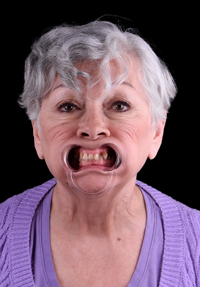 Elder woman, patient from Prime Advanced Dentistry snap-on dentures before and after