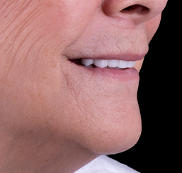 close up shot at an elder woman snap-on dentures