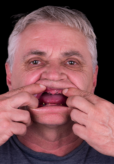 Elder man, patient from Prime Advanced Dentistry snap-on dentures before and after 