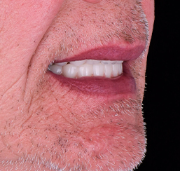  close up shot at an elder man snap-on dentures