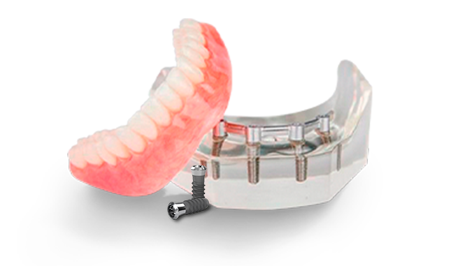 Titanium implant snap-on denture for the lower jaw