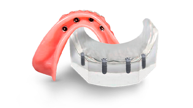 cost of snap-on dentures in Mexico