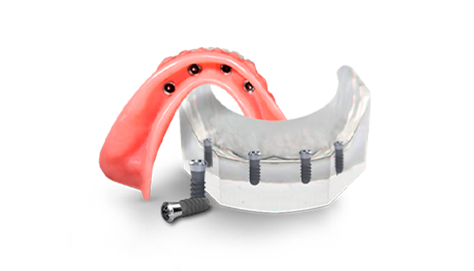  bar-retained snap-on denture for the lower jaw