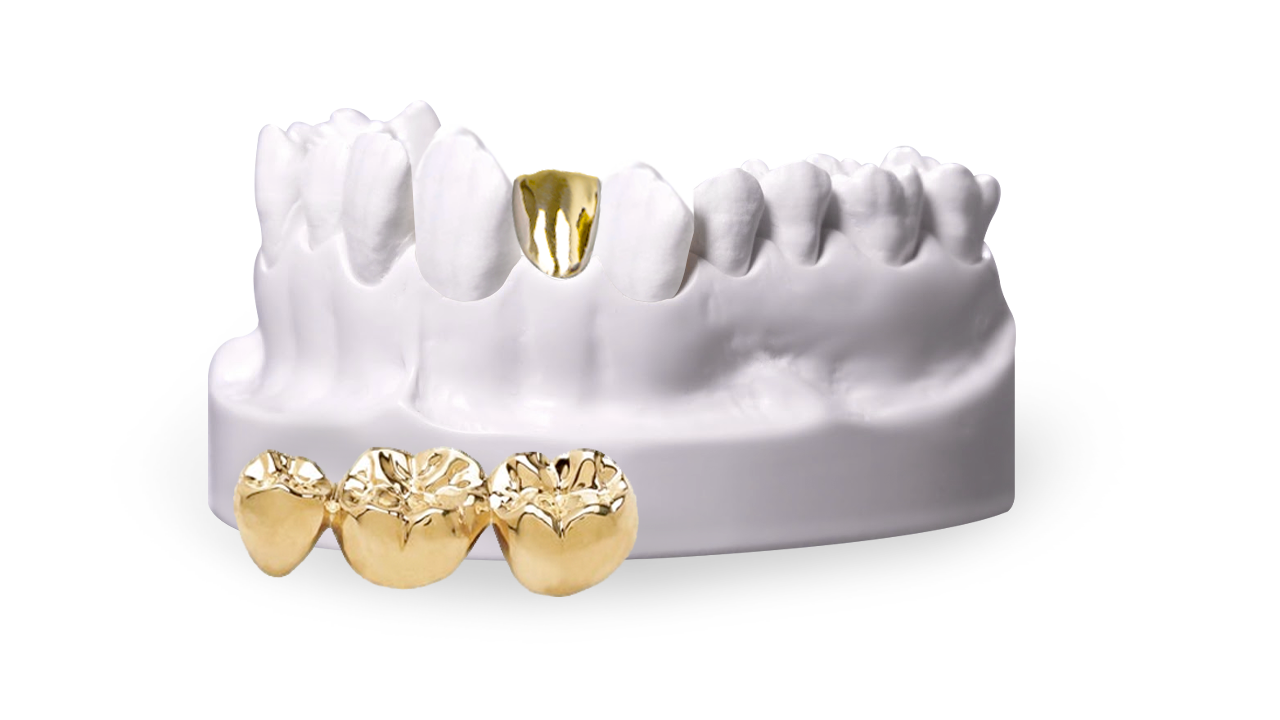 gold dental crowns in Mexico