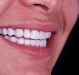 close-up shot at a patients smile with zirconia crowns